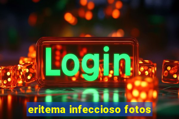eritema infeccioso fotos