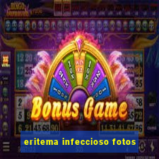 eritema infeccioso fotos